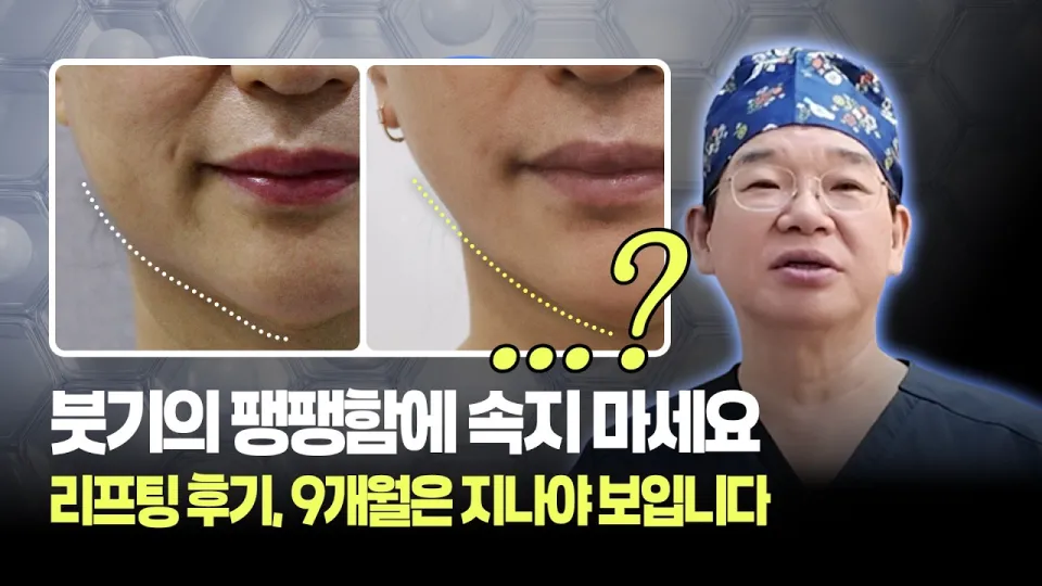 리프팅시술을 효과적으로 하는 방법과 9개월 후 진짜 라인 확인법