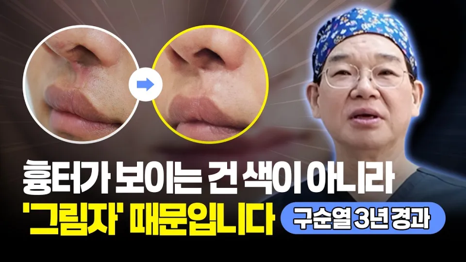 구순구개열 흉터, 다시 자르지 않고 지방줄기세포로 개선하는 방법